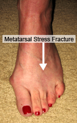 Metatarsal Stress Fractures treatemtn Boulder