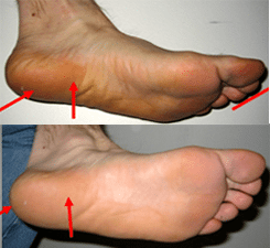 Plantar Fasciitis and Orthotics PTI Orthotics Longmont