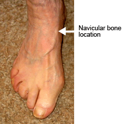 Accessory Navicular Bone
