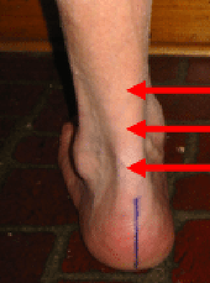 Achilles Tendonitis