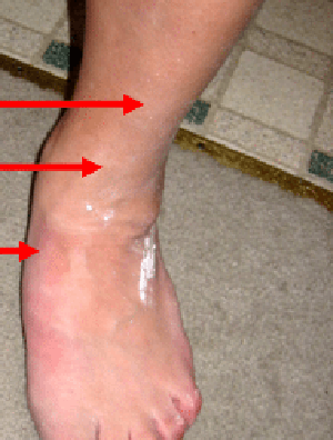 Anterior Tibial Tendonitis