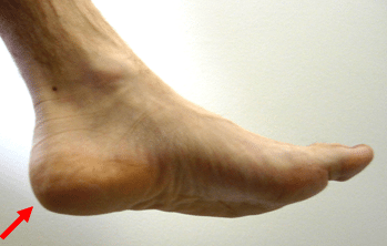 Calcaneal Apophysits