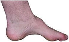 Charcotte Marie Tooth Disease