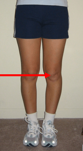 Chrondromalacia Patella
