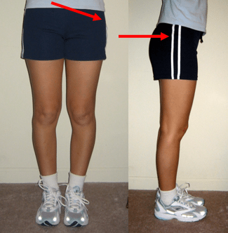Gluteous Medius Syndrome