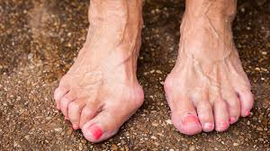 Hallux Valgus