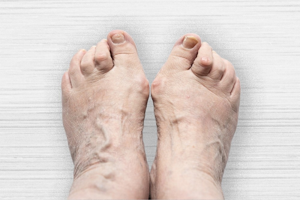 Hammer Toe/ Claw Toe