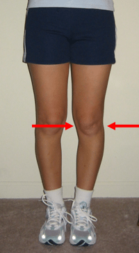 Knee Arthritis