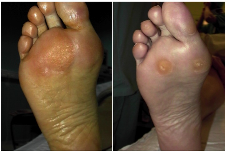 Metatarsalgia