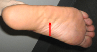 Mid Foot Plantar Fasciitis