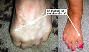 Morton's Toe