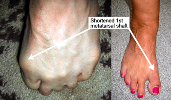 Morton's Toe
