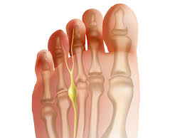 Neuroma