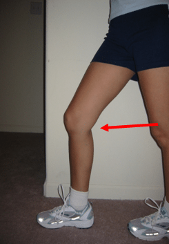 Pes Anserine Bursitis
