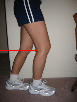 Popliteal Tendinitis