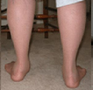 Posterior Tibial Tendonitis