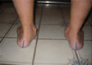 Pronation – Pes Planus