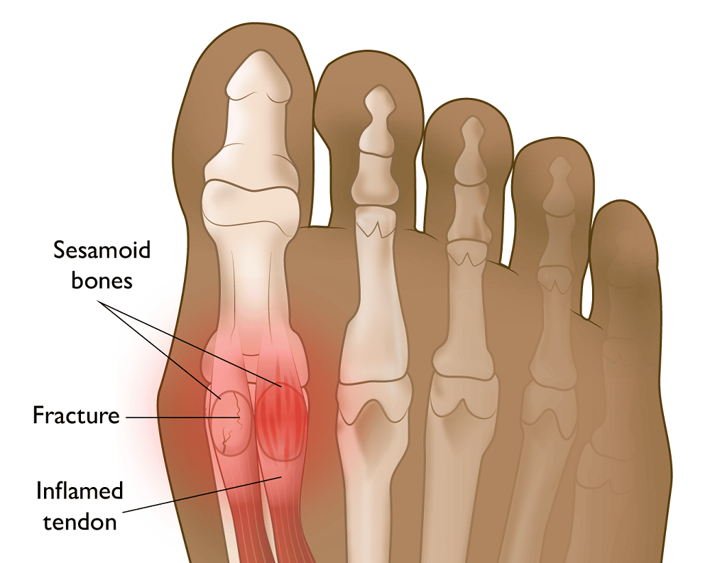 Sesamoiditis