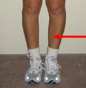 Shin Splints