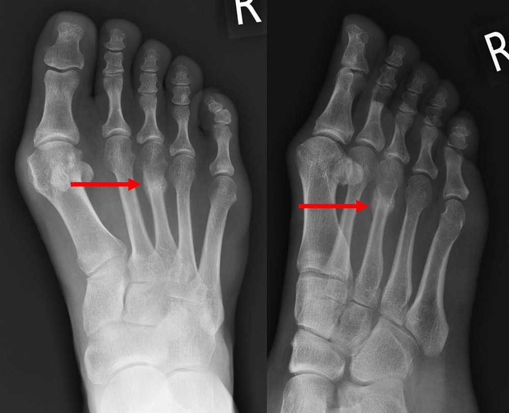 Metatarsal Stress Fractures