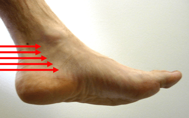 Tarsal Tunnel Syndrome