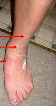 Anterior Tibialis Tendonitis