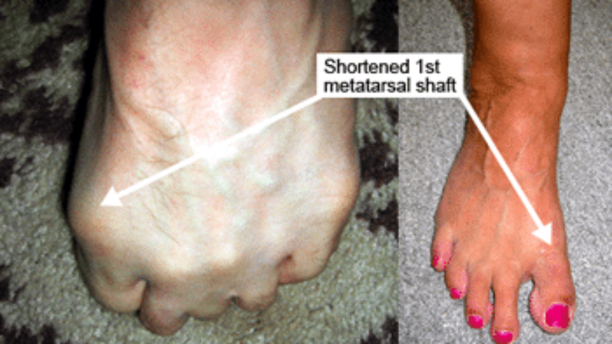 Mortons Toe | Foot Pain Care | PTI 